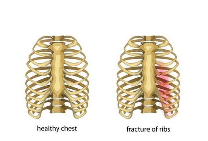 Are bruised ribs worse than broken?