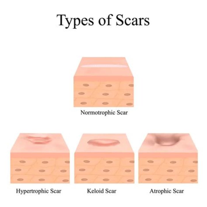 Are keloids hard or soft?