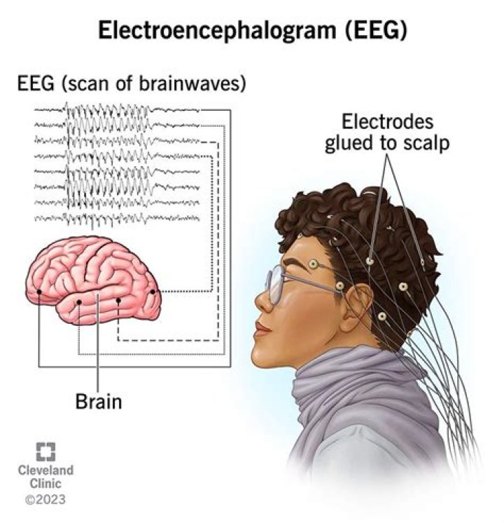 Can an EEG detect nerve damage?