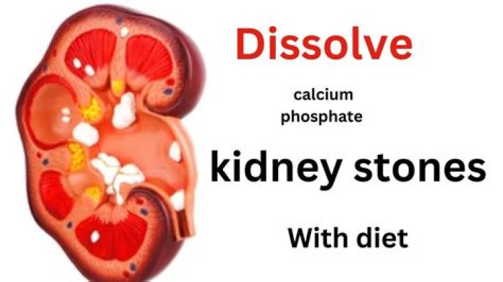 Can anything dissolve kidney stones?
