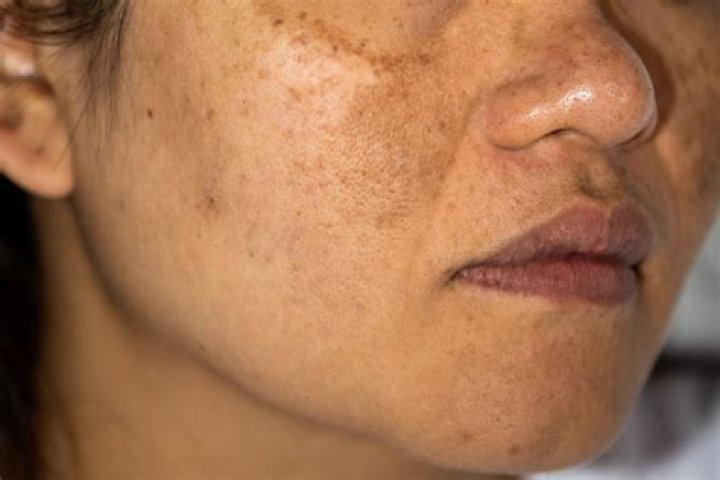 Can hyperpigmentation be cured permanently?