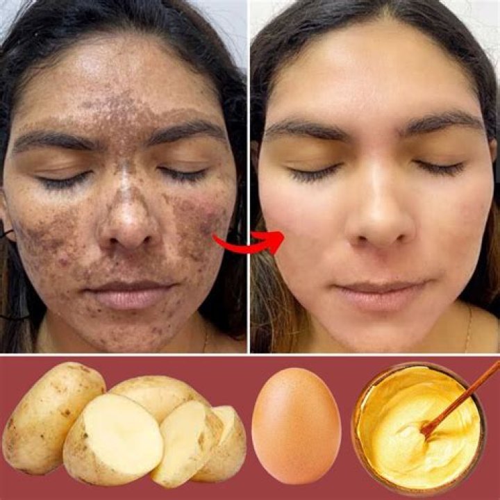 Can potato remove wrinkles?