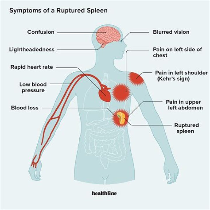 Can the spleen cause back pain?