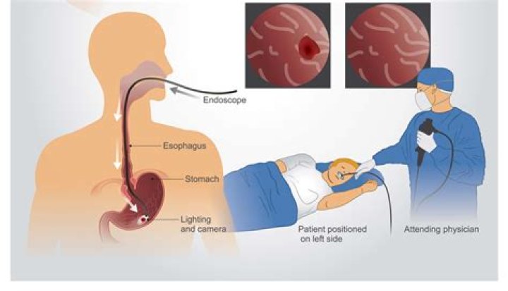 Can you be awake for endoscopy?