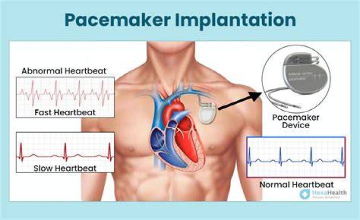 Can you drive with a pacemaker?