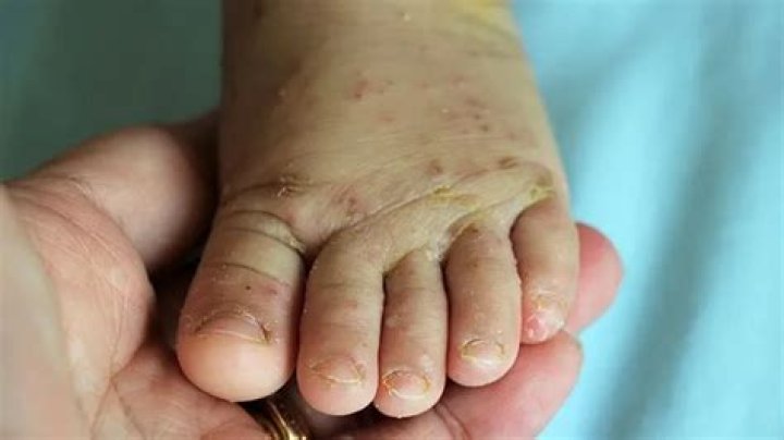 Can you pass scabies through kissing?