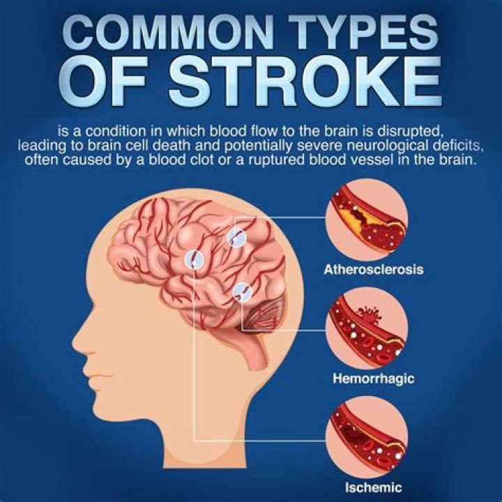 Do emotions come back after a stroke?