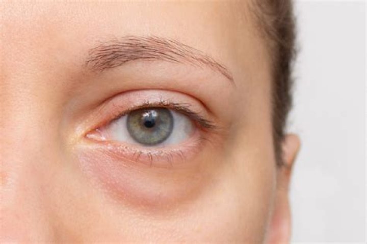 Do Eyebags make you look old?