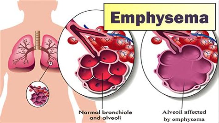 Do welders get emphysema?