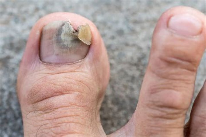 Does cutting an ingrown toenail make it worse?