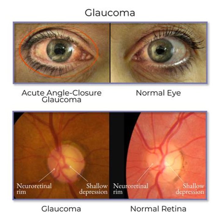 Does glaucoma hurt?