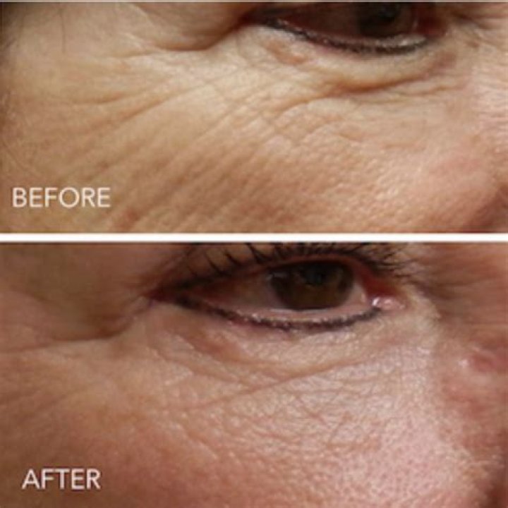 Does microneedling cause wrinkles?