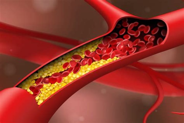 Does PET scan show clogged arteries?
