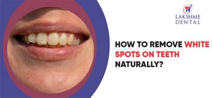 How do I get rid of white spots on my teeth naturally?