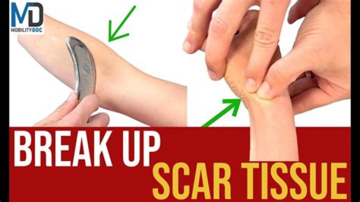 How do you break up hard scar tissue?