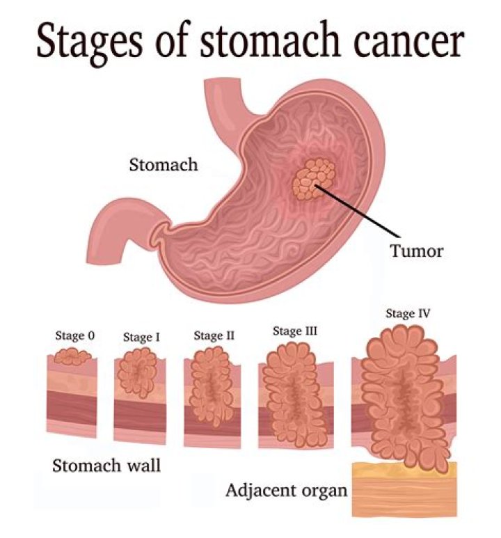 How do you get rid of tumors without surgery?