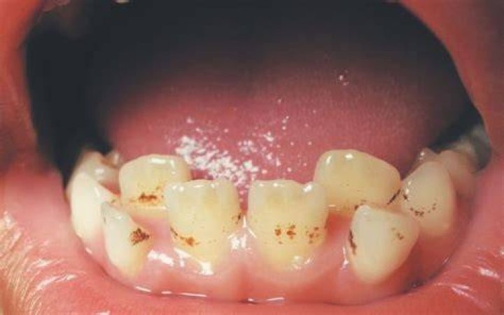 How do you get stains off kids teeth?