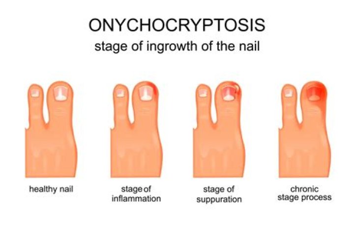 How does Epsom salt help ingrown toenail?