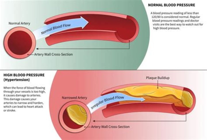 How does high blood pressure lead to seizures?
