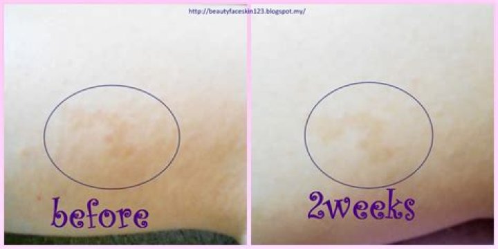 How long does it take for Bio-Oil to work?