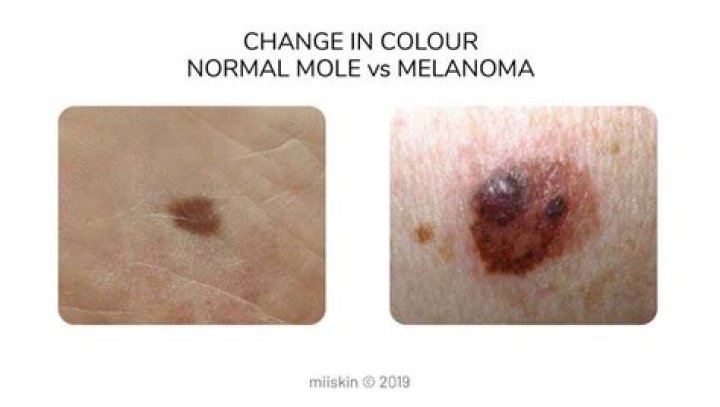 How quickly does a mole change into melanoma?