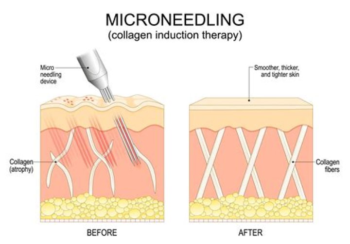 Is microneedling more effective than laser?