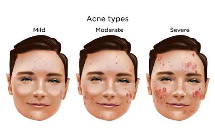 Should I shower everyday if I have acne?