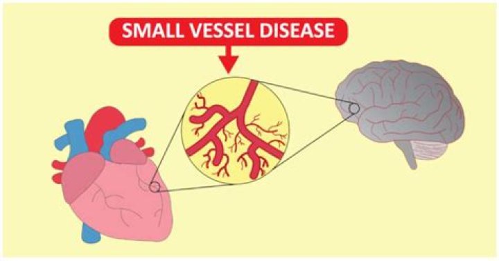 What are the symptoms of small vessel disease of the brain?