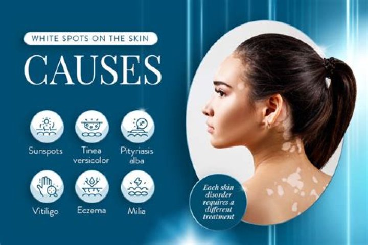 What autoimmune disease causes white spots on skin?