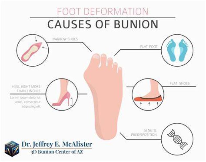 What do bunions do to your body?