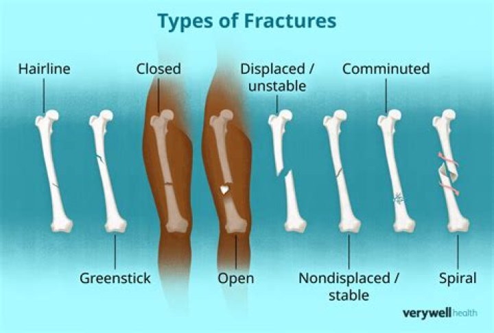 What does a hairline fracture rib feel like?