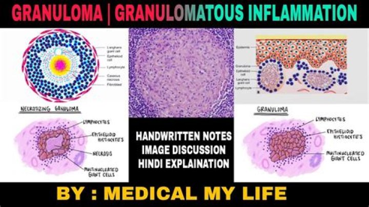What does granuloma feel like?
