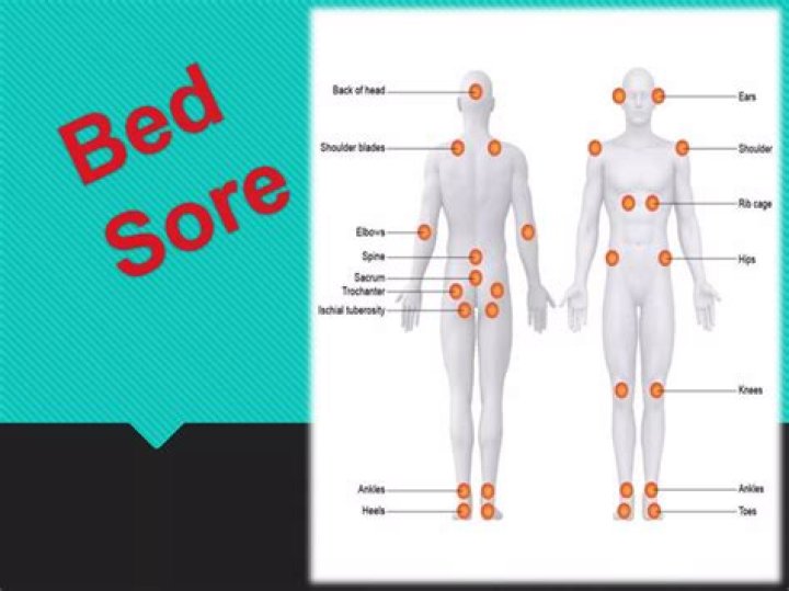 What happens if a bed sore reaches the bone?