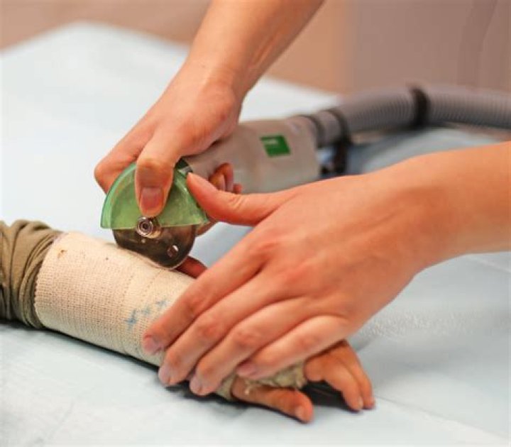 What is a plaster cast made of?