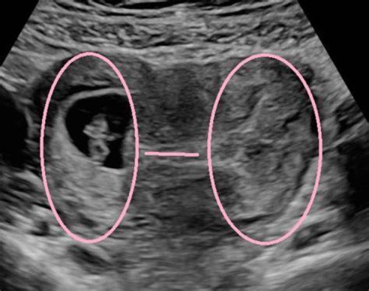 What is bright white on ultrasound?