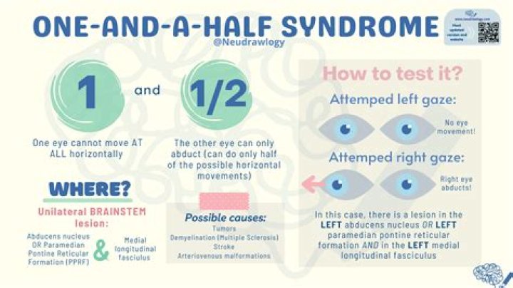 What is one and a half syndrome?