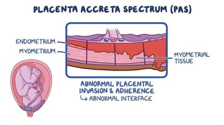 What is PAS TB?