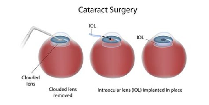 What is the failure rate of cataract surgery?
