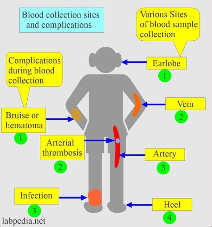 What is the most common complication of phlebotomy?