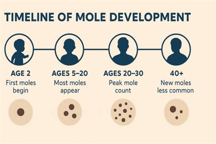 What types of moles should be removed?