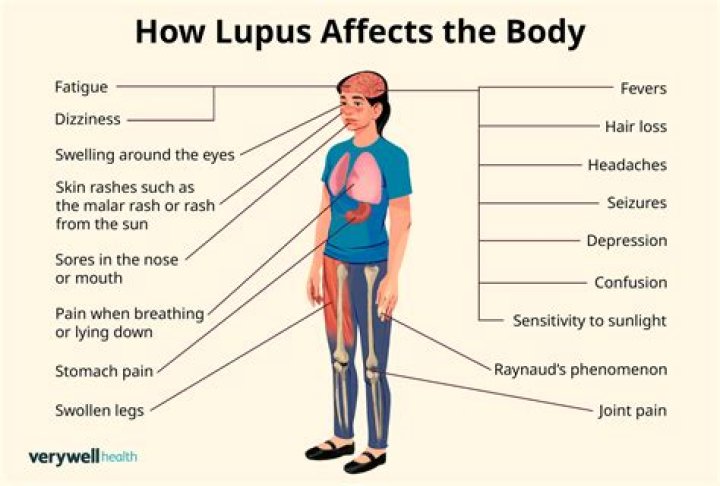 Where is lupus pain?