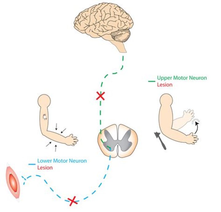 Who has motor neuron disease in The Split?