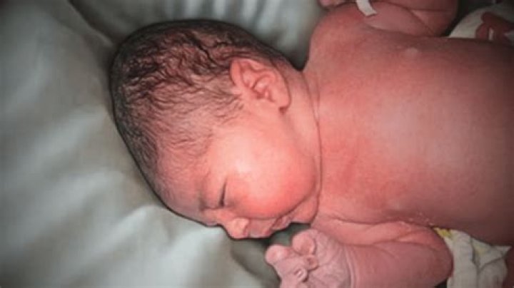 Why do babies get birthmarks?
